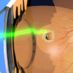 Effective Private Laser Therapy for Retina: Innovative Treatment Choices