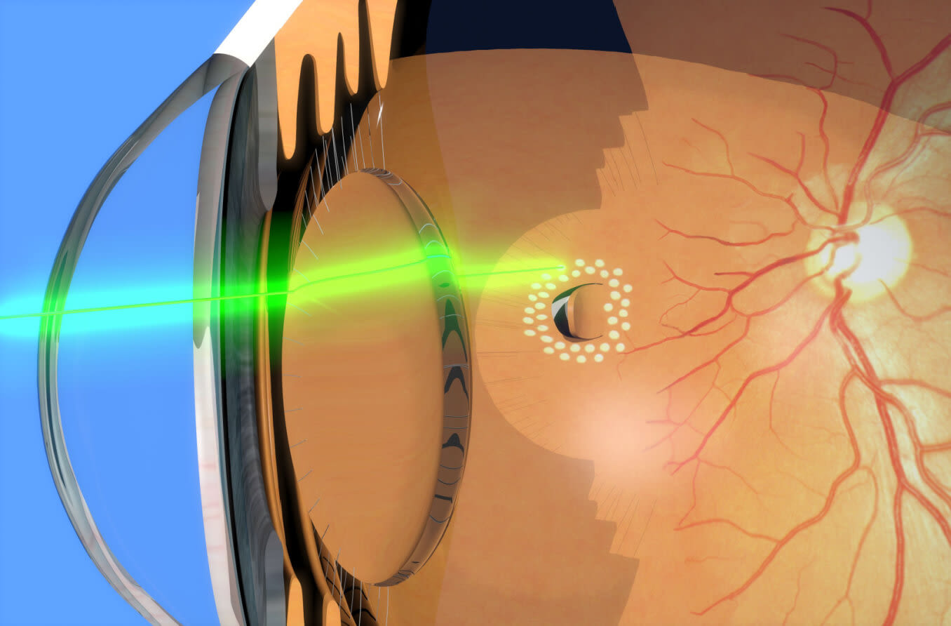 Effective Private Laser Therapy for Retina: Innovative Treatment Choices