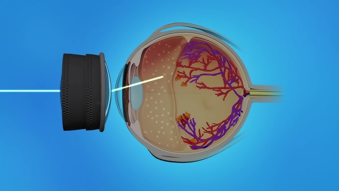 Effective Private Laser Therapy for Retina